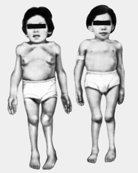 Рис. 5. Синдром Моркио: типичные внешние проявления