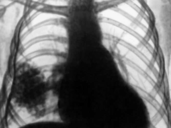 Рис. 4. Рентгенограмма органов грудной клетки больного, перенесшего правосторонний гнойный плеврит (прямая проекция): в правом легочном поле видны плотные тени участков обызвествления плевры