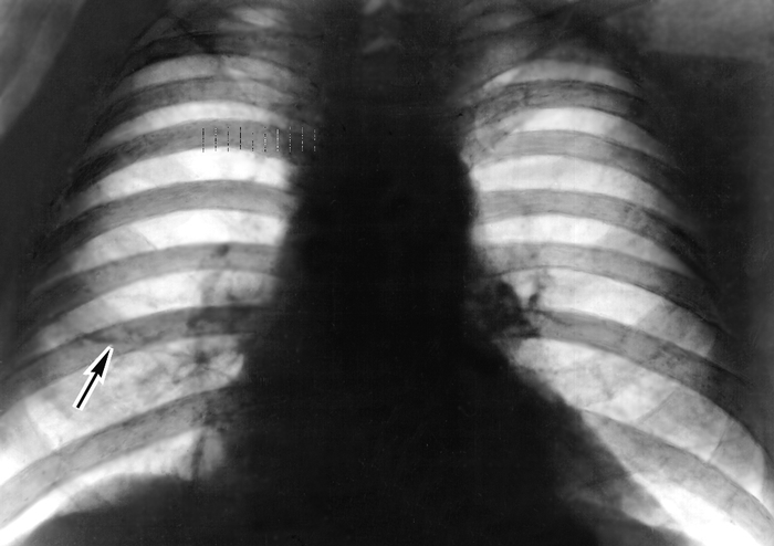 Рис. 4. Рентгенограмма грудной клетки (прямая прекция) больного саркоидозом легких: диффузное усиление и деформация легочного рисунка, дисковидный ателектаз (указан стрелкой)