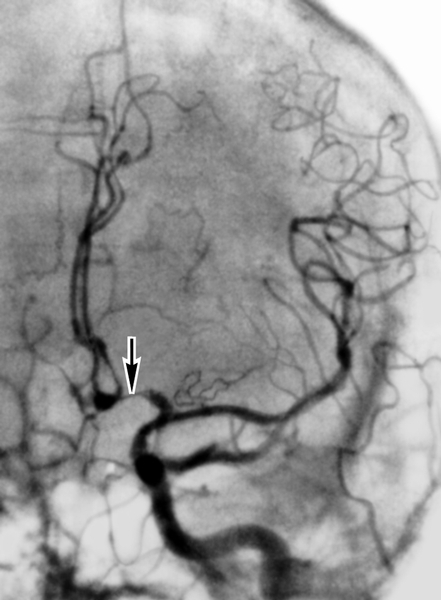 Рис. 3а). Каротидная ангиограмма (левосторонняя) больного с аневризмой передней соединительной артерии: выраженный <a href=