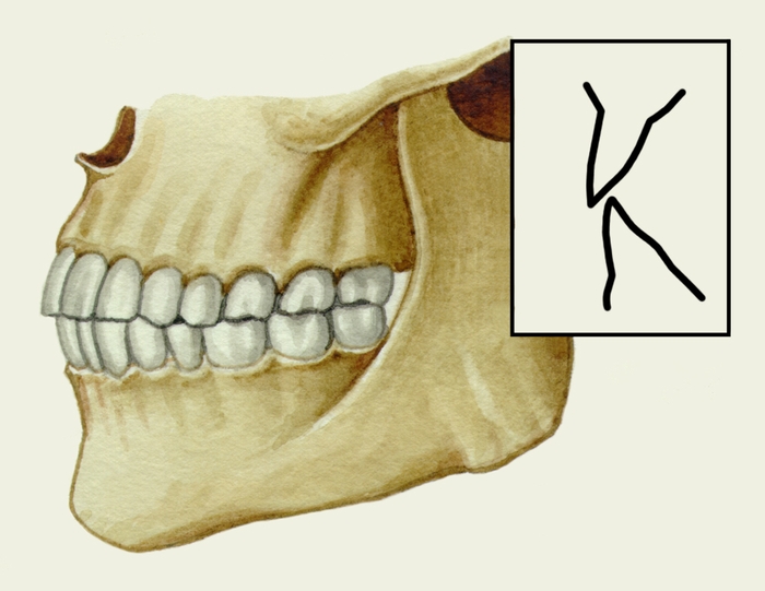 Рис. 1а). Схематическое изображение челюстей при основных разновидностях нормального прикуса (вид сбоку): ортогнатический прикус
