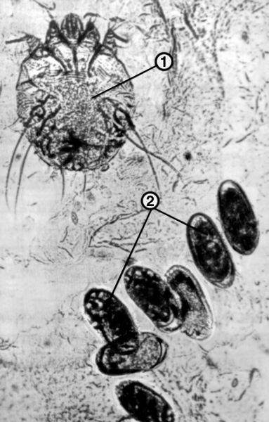 Рис. 3. Микропрепарат соскоба чешуек эпидермиса при чесотке: 1 — самка чесоточного клеща; 2 — яйца с эмбрионами