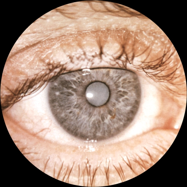 Рис. 2. Зрелая старческая катаракта: в области зрачка виден мутный хрусталик серого цвета