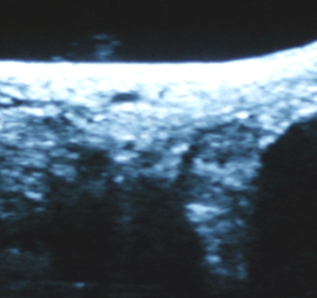 Рис. 8б). Ультрасонограмма пяточных сухожилий после разрыва сухожилия: область разрыва сухожилия замещена рубцовой тканью