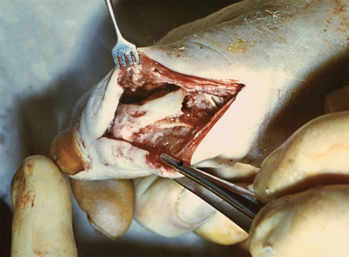 Рис. 11б). Пандактилит I пальца правой кисти: на операции видна деструкция кости основной фаланги и пястно-фалангового сустава, некроз мягких тканей