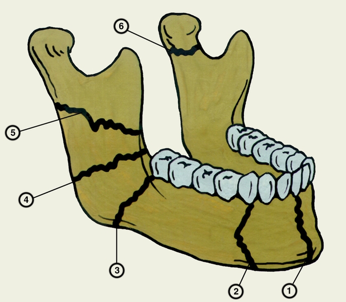 Рис. 3. Схематическое изображение локализации типичных переломов нижней челюсти: 1 — срединный перелом; 2 — подбородочный перелом; 3 — перелом впереди угла челюсти; 4 — перелом позади угла челюсти; 5 — перелом ветви челюсти; 6 — перелом шейки челюсти
