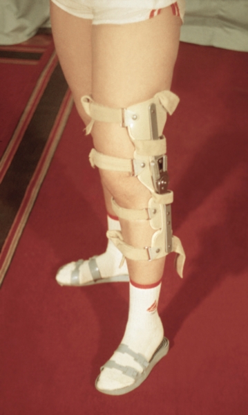 Рис. 3. Замковый ортез для левого коленного сустава, ограничивающий отклонения голени в сторону и обеспечивающий активное <a href=