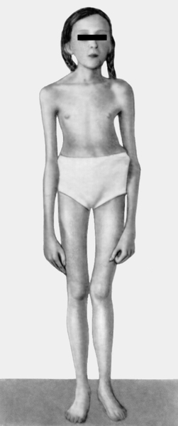 Рис. 2. Девочка с выраженными признаками синдрома Марфана: астеническое телосложение, «птичье лицо», конечности удлинены, арахнодактилия, деформированная грудная <a href=