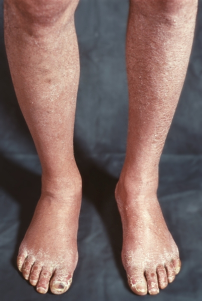 Рис. 1. Ноги больного с синдромом Лериша: бледность кожи нижних конечностей, выпадение волос, <a href=