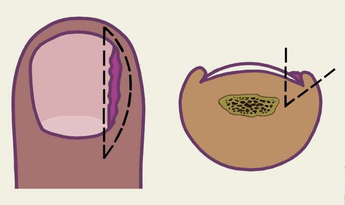 Рис. а). Схематическое изображение этапов операции по поводу вросшего ногтя: пунктиром обозначен участок удаляемых тканей