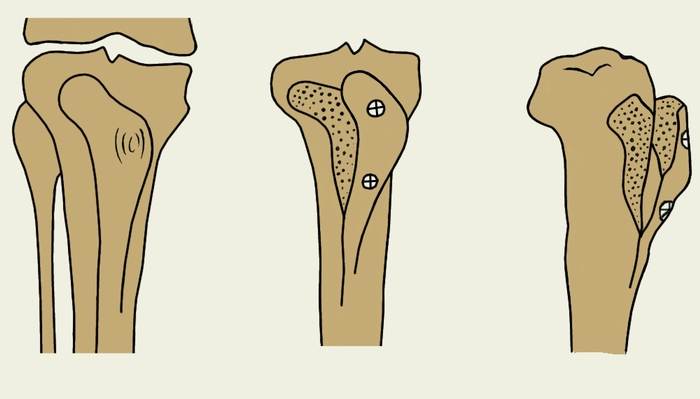 Рис. 4б). Схематическое изображение корригирующих остеотомий при гонартрозе: этапы операции антеромедиализации бугристости большеберцовой кости