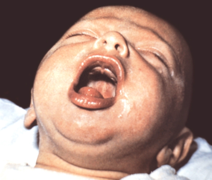 Рис. 1б). Внешний вид ребенка, больного коклюшем, во время приступа спазматического кашля: разгар приступа