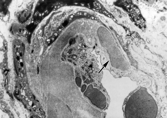 Рис. 2. Электронограмма приносящего сосуда почечного клубочка при доброкачественной форме нефросклероза: скопление гиалиновых масс под эндотелием (указано стрелкой); ×6000