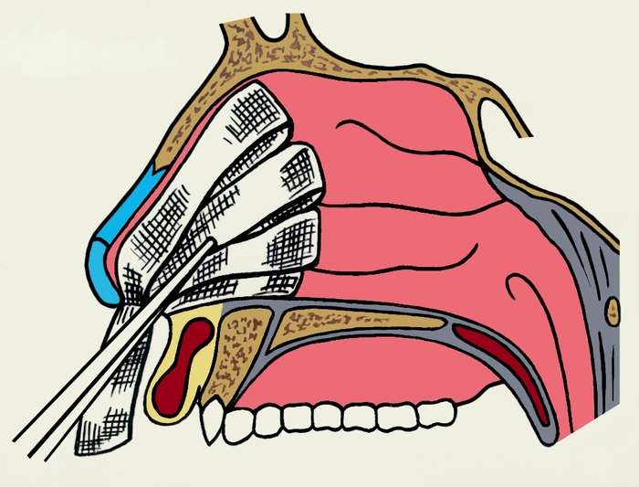 Рис. 1. Схематическое изображение передней тампонады передних отделов полости носа