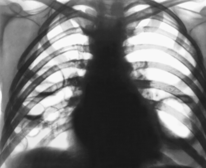 Рис. 14. Рентгенограмма органов грудной клетки в прямой проекции при септической пневмонии: в обоих легочных полях видны многочисленные округлые просветления — тонкостенные полости, в некоторых полостях определяется жидкость — затенение с горизонтальной верхней границей