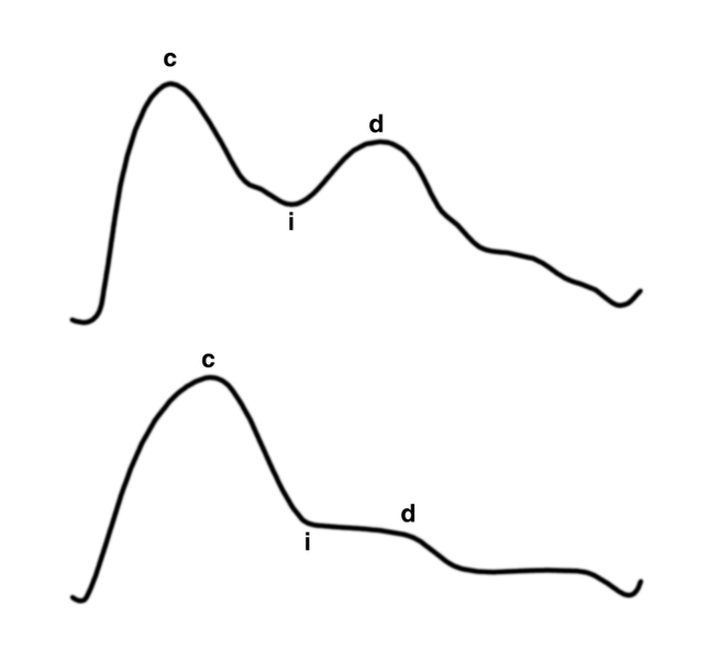 Рис. 2. Нормальные реовазограммы предплечья (вверху) и голени (внизу): c — вершина систолической волны; d — вершина диастолической волны; i — инцизура. На реограмме голени диастолическая волна и инцизура выражены менее четко и расположены ближе к основанию волны, чем на реовазограмме предплечья