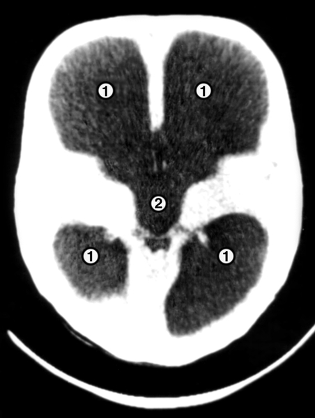 Рис. 4. Компьютерные томограммы головы грудного ребенка с гидроцефалией: на срезах, выполненных на разных уровнях, видно резкое расширение боковых (1) и третьего (2) желудочков