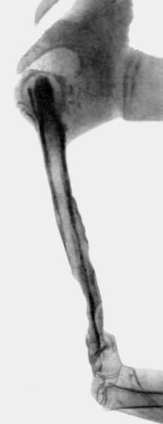 Рис. 2в). Рентгенограмма правой верхней конечности при прогрессирующем остеолизе плечевой кости: начинающееся рассасывание трансплантанта