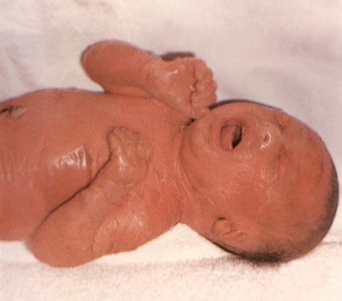 Рис. 3. Новорожденный с ихтиозиформной эритродермией: генерализованная <a href=