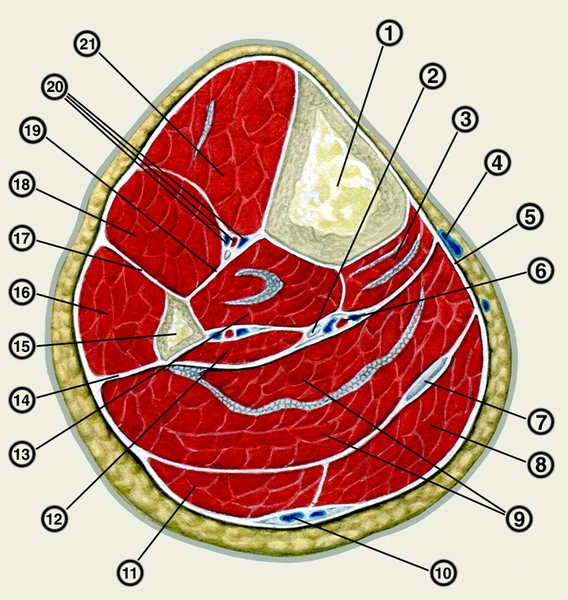 Рис. 2. Поперечный распил левой голени: 1 — большеберцовая кость; 2 — большеберцовый нерв; 3 — длинный сгибатель пальцев; 4 — большая подкожная вена ноги; 5 — фасция голени; 6 — задние большеберцовые артерия и вены; 7 — сухожилие подошвенной мышцы; 8 — медиальная головка икроножной мышцы; 9 — камбаловидная мышца; 10 — малая подкожная вена ноги; 11 — латеральная головка икроножной мышцы; 12 — длинный сгибатель большого пальца стопы; 13 — задняя большеберцовая мышца; 14 — задняя межмышечная перегородка голени; 15 — малоберцовая кость; 16 — длинная малоберцовая мышца; 17 — передняя межмышечная перегородка голени; 18 — длинный <a href=
