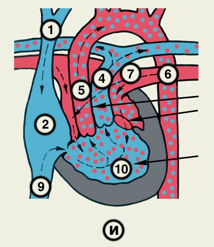 Рис. 23и). Схематическое изображение отдельных врожденных пороков сердца (направления кровотока обозначены пунктирными стрелками, локализация пороков — сплошными стрелками): трехкамерное сердце с единым желудочком; 1 — верхняя полая вена, 2 — правое предсердие, 4 — легочный ствол, 5 — аорта, 6 — легочная вена, 7 — левое предсердие, 9 — нижняя полая вена, 10 — единый желудочек