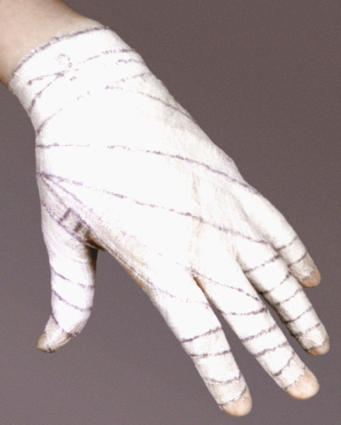 Рис. 4б). Спиральная повязка на все пальцы кисти: готовая повязка — «перчатка»