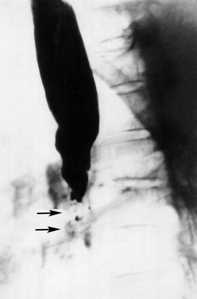 Рис. б). Рентгенологическая картина при различных заболеваниях и поражениях пищевода, сопровождающихся дисфагией: циркулярное сужение с неровными контурами (указано стрелками) при эндофитном раке пищевода