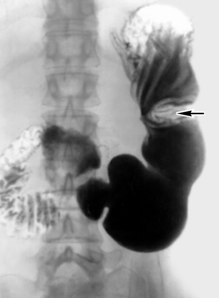 Рис. 3. Рентгенограмма желудка (прямая проекция) при язве малой кривизны: стрелкой указано втяжение контура большой кривизны желудка, обусловленное локальным спазмом