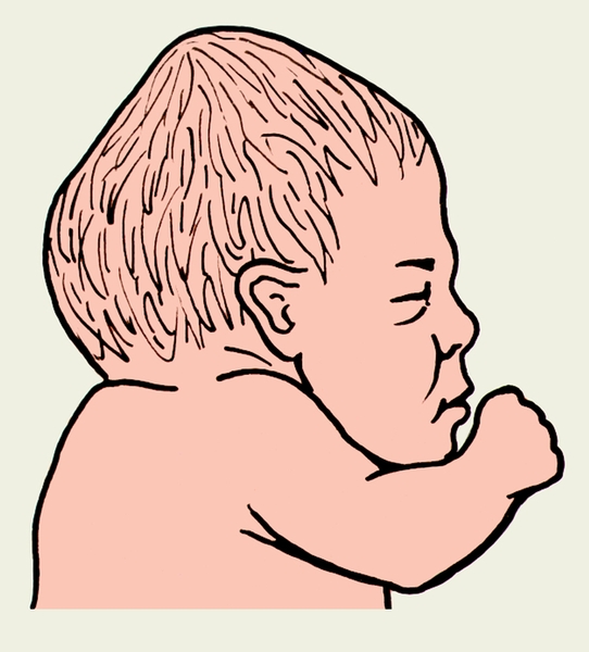 Рис. 16а). Брахицефалическая форма головки плода, образовавшаяся в результате родов в передне-головном предлежании