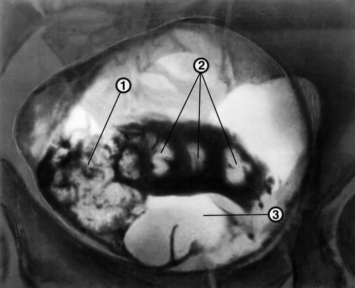 Рис. 2. Лакунарная цистограмма больного с аденомой предстательной железы, папиллярной опухолью и камнями мочевого пузыря: 1 — папиллярная <a href=