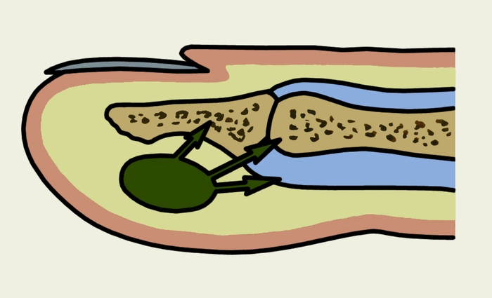 Рис. 2. Схема распространения гноя при подкожном панариции в кость фаланги, в межфаланговый сустав и в сухожильное влагалище