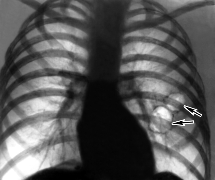 Рис. 2а). Рентгенограмма грудной клетки (прямая проекция) при буллезной эмфиземе легких: в левом легком видны тонкостенные полости овальной формы (указаны стрелками)