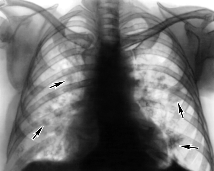 Рис. 1б). Рентгенограмма грудной клетки (прямая проекция) больного с эозинофильными летучими инфильтратами — множественные инфильтраты в правом и левом легких (указаны стрелками)