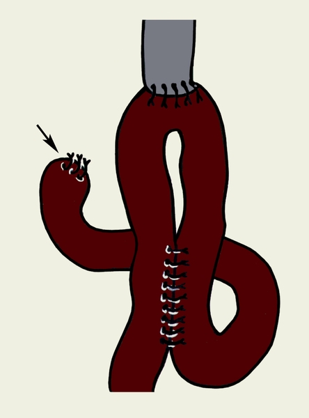 Рис. 10. Схематическое изображение эзофагоеюноанастомоза с энтероэнтероанастомозом после гастроэктомии (стрелкой указана ушитая <a href=