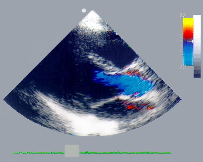 Рис. 6б). Двухмерная цветная допплер-эхокардиограмма с изображением сердца в проекции длинной оси: в период систолы, синий <a href=