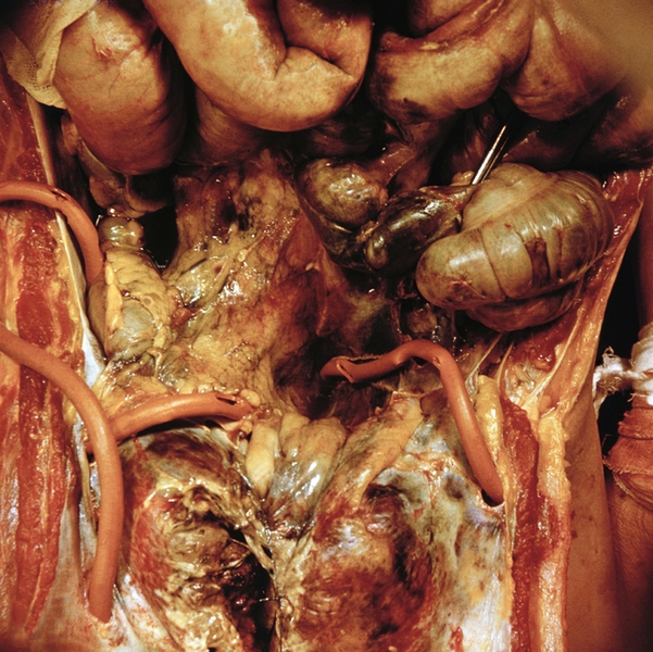 Рис. 1а). Макроскопическая картина вскрытой брюшной полости при гнойном перитоните: абсцессы с подведенными к ним дренажами
