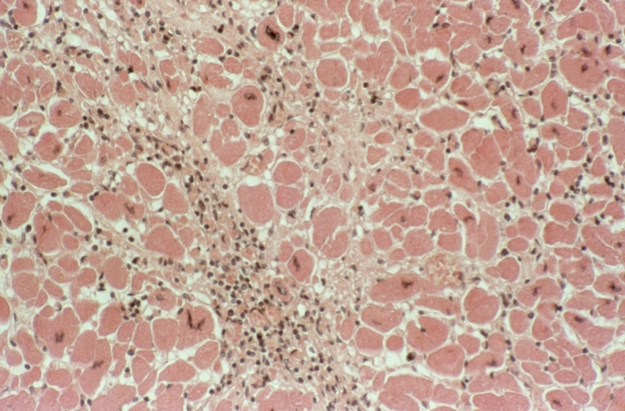 Рис. 18. Микропрепарат сердца при протозойном миокардите Шагаса: в миокарде очаговые и диффузные инфильтраты, состоящие из лимфоцитов и гранулоцитов, небольшого количества эозинофилов и отдельных плазматических клеток; в инфильтрате и вокруг инфильтратов видны нежные соединительнотканные волокна, миофибриллы гипертрофированы; окраска гематоксилином и эозином; ×320