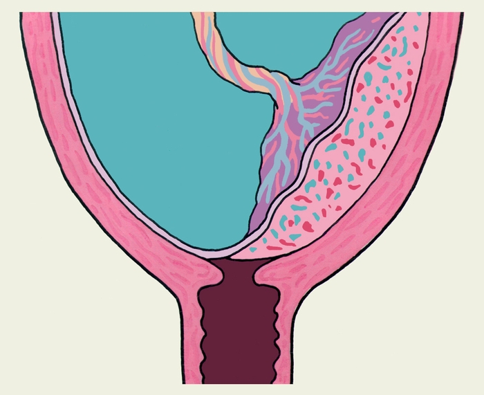 Рис. 1а). Схематическое изображение частичного предлежания плаценты (на фронтальном разрезе матки)