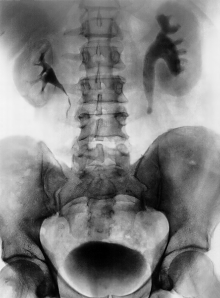 Рис. 2б). Рентгенограмма брюшной полости и таза больного мочекаменной болезнью — выраженная каликопиелоуретерэктазия выше уровня камня на экскреторной урограммме