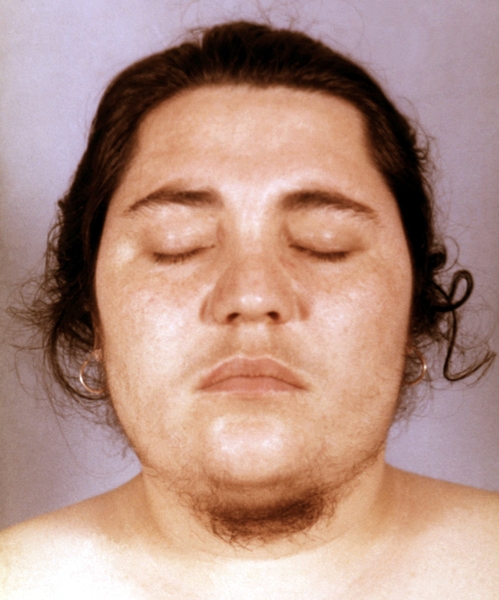 Больная с андростеромой; отчетливо виден рост волос на лице по мужскому типу (гирсутизм)