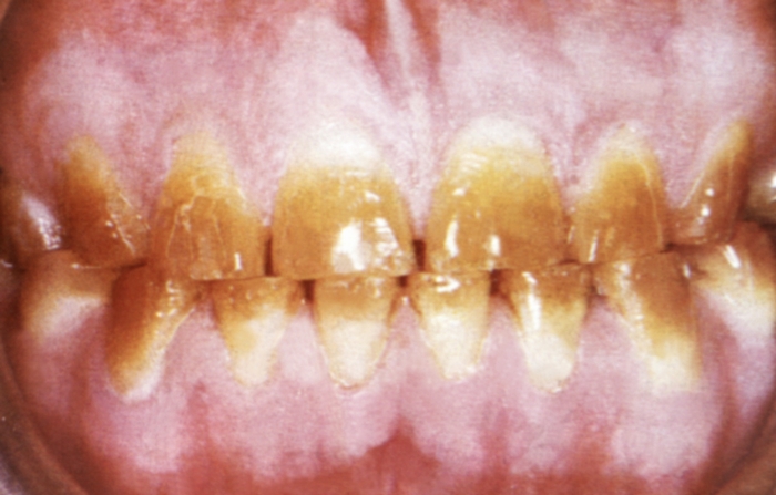 Рис. 7. Тетрациклиновые зубы: коронки окрашены в желтый цвет