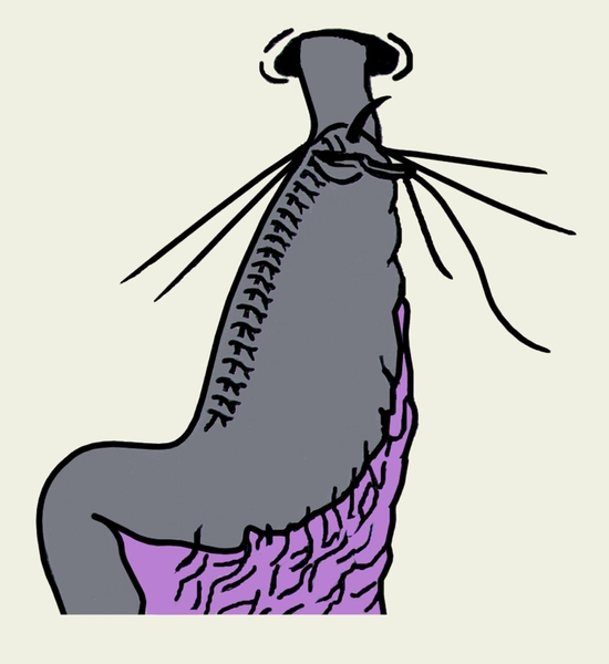 Рис. 9. Схематическое изображение проксимальной резекции желудка