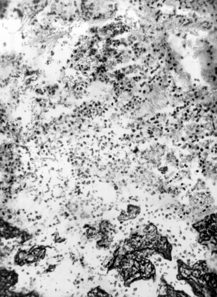 Рис. 3а). Микропрепарат легкого при стрептококковой пневмонии: очаг пневмонии с распадом лейкоцитов (в центре) и фибринозным выпотом (по периферии); окраска анилиновым фиолетовым по Граму — Вейгерту; ×135