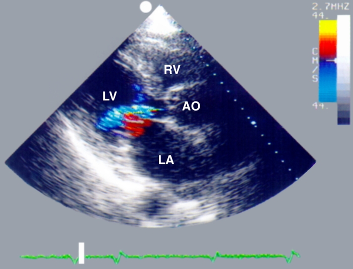 Рис. 17. Двухмерная цветная допплер-эхокардиограмма при митральной недостаточности (LV — левый желудочек сердца, LA — левое предсердие, АО — аорта): в систолу зафиксирован мозаичный турбулентный поток митральной регургитации 3 степени (MR+++) через не полностью сомкнутые створки митрального клапана