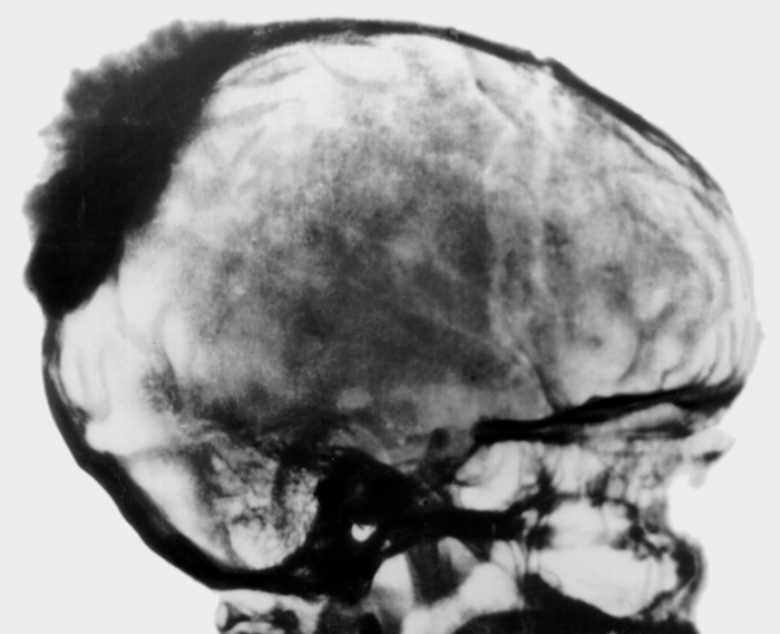 Рис. 9. Боковая рентгенограмма черепа больного при остеогенной саркоме теменно-затылочной области: плотная тень опухоли с выраженной периостальной реакцией в виде веерообразно расходящихся неравномерных спикул