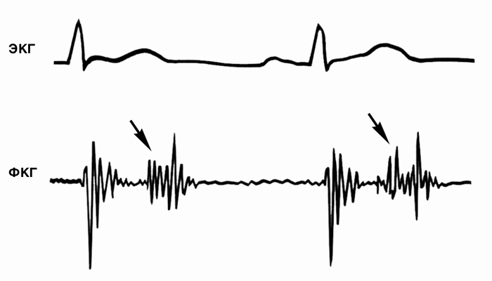Рис. 7а). Фонокардиограмма (с точки Боткина — Эрба) больного с пролапсом митрального клапана (в положении лежа): мезосистолический щелчок (указан стрелками) и телесистолический шум