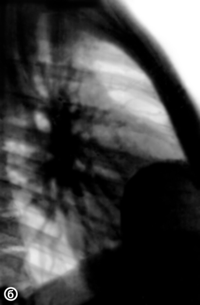 Рис. 3б). Рентгенограмма грудной клетки (боковая проекция) больного с целомической кистой перикарда; в правом кардиодиафрагмальном углу круглая тень кисты, вплотную прилежащая к сердечной тени
