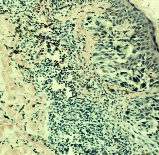 Рис. 2. Микропрепарат меланомы кожи: ячейки опухолевых клеток в сосочковом и сетчатом слоях дермы. <a href=