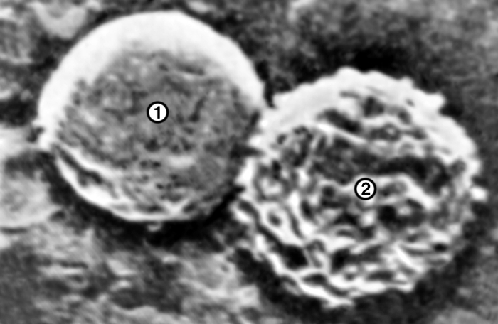 Рис. 3б). Микрофотография лимфоцитов: при сканирующей электронной микроскопии (1 — гладкий Т-лимфоцит, 2 — ворсинчатый В-лимфоцит, ×3000)