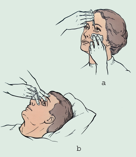 Рис. 2. Закапывание глазных капель: а — в положении больного сидя; б — в положении больного лежа